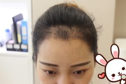 点击看大图 -大麦微针植发丨全国连锁