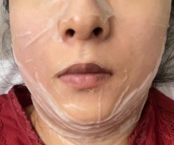 体验后-海涛医疗美容·面部抗衰·注射美鼻