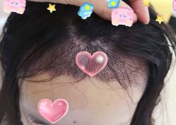 -大麦微针植发全国连锁