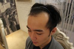 点击看大图 -大麦微针植发丨全国连锁