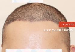 -大麦微针植发全国连锁