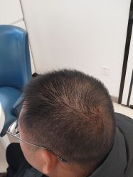-大麦微针植发丨全国连锁