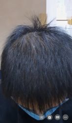 点击看大图 体验后-熙朵美学植发连锁