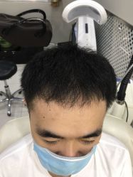 点击看大图 -大麦微针植发全国连锁