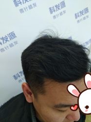 -大麦微针植发丨全国连锁