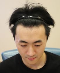 点击看大图 -大麦微针植发全国连锁
