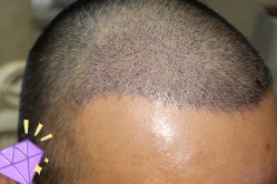 -大麦微针植发丨全国连锁