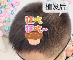 -大麦微针植发全国连锁