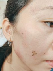 -北京美痣堂古方祛痣斑疣瘊