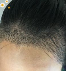 -大麦微针植发丨全国连锁