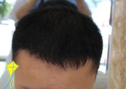 -大麦微针植发丨全国连锁