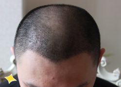 -大麦微针植发丨全国连锁