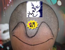 -大麦微针植发全国连锁