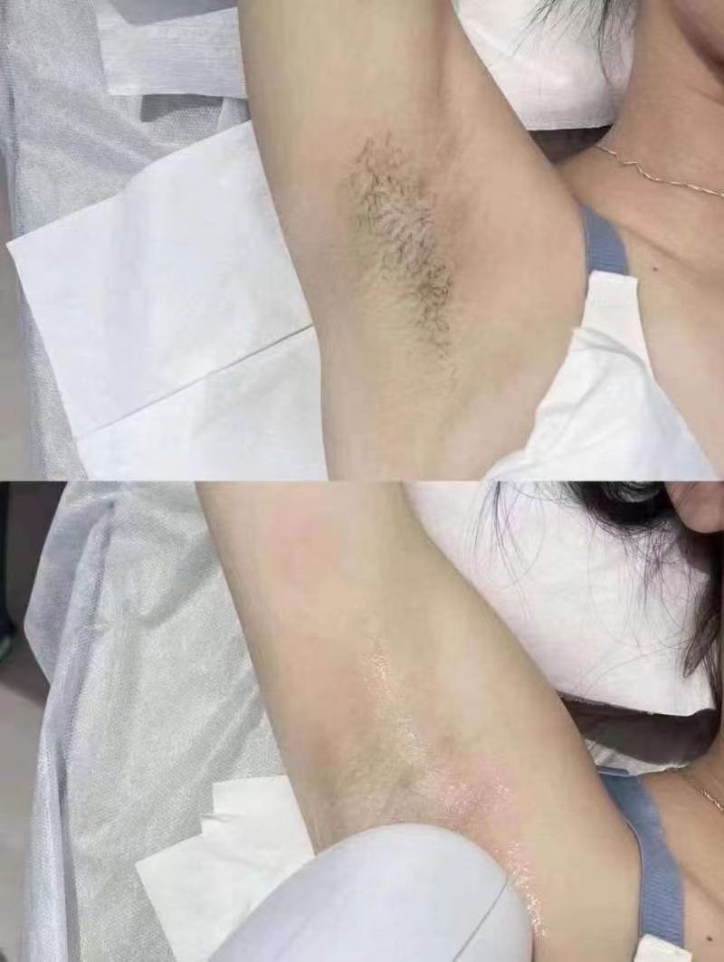 脱毛
