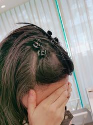 -碧莲盛·不剃发植发