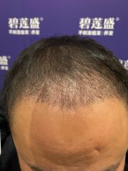 -碧莲盛·不剃发植发