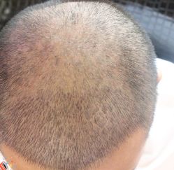 -大麦微针植发丨全国连锁