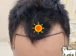 -大麦微针植发全国连锁