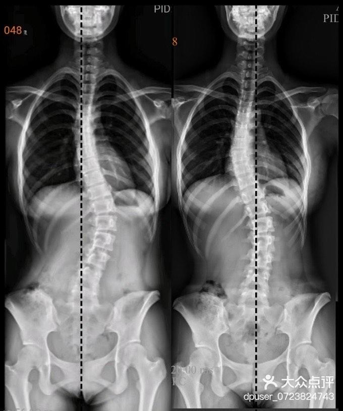 成长轨迹:骨骼x光对比