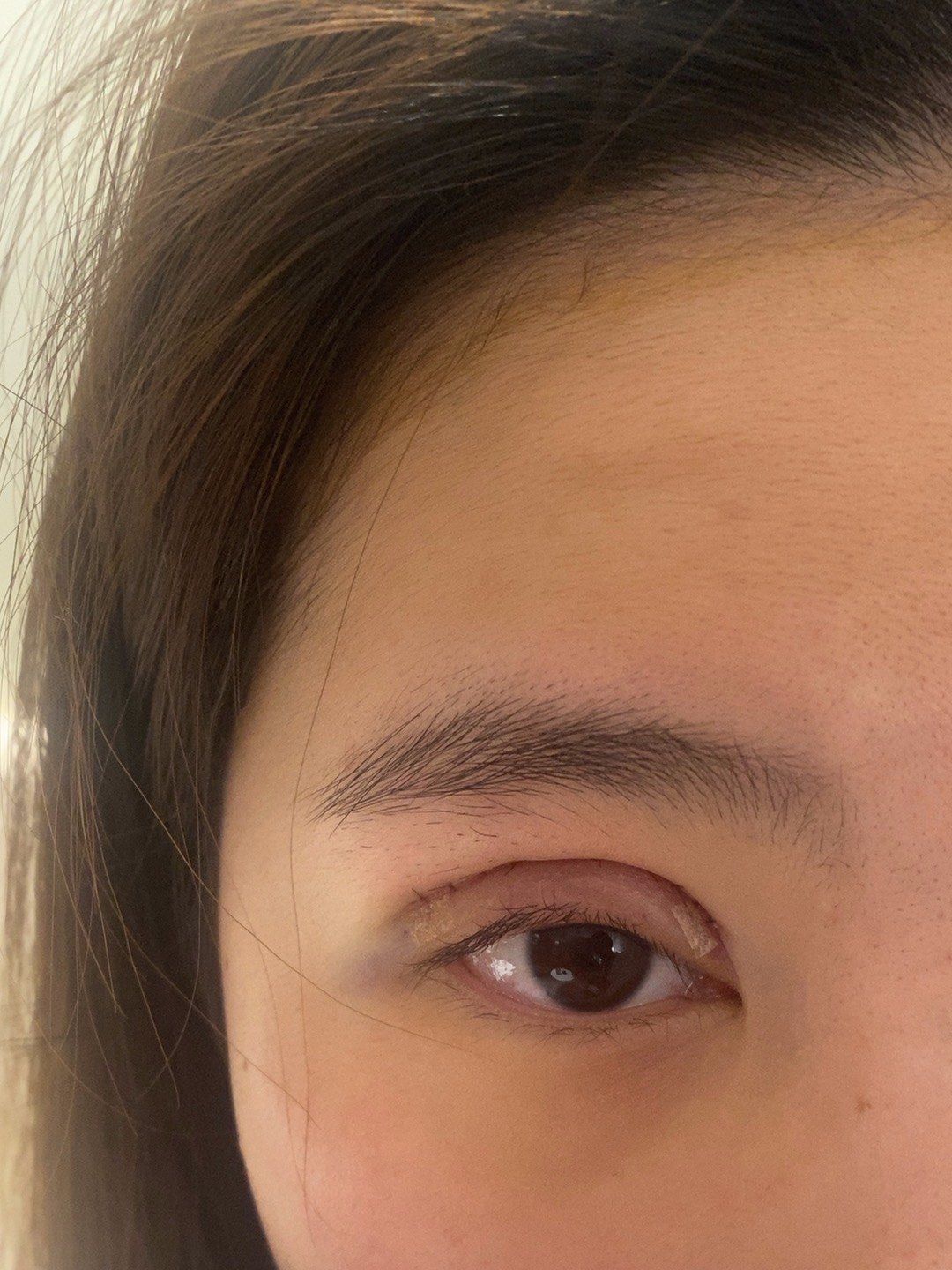 7mm的开扇型双眼皮