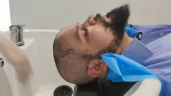 -大麦微针植发全国连锁