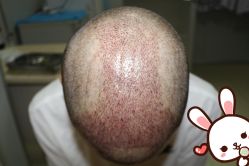 -大麦微针植发丨全国连锁