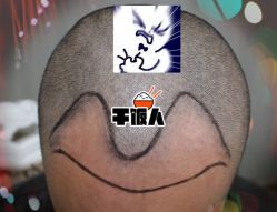 -大麦微针植发全国连锁