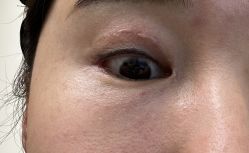 体验后-成都艾特他整形外科医院