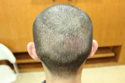 点击看大图 -大麦微针植发丨全国连锁