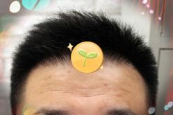 -大麦微针植发全国连锁