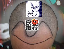 -大麦微针植发全国连锁