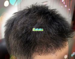 -大麦微针植发全国连锁