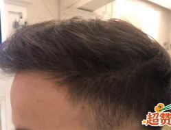 -大麦微针植发全国连锁