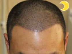 -大麦微针植发丨全国连锁