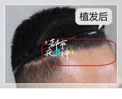 -大麦微针植发全国连锁