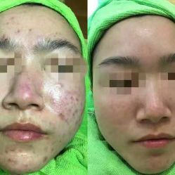 -苗医生草本科技祛痘