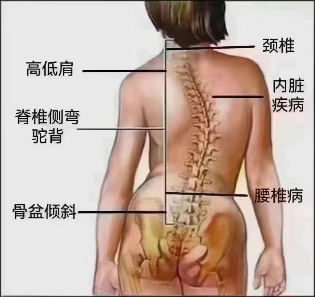 五脏六腑都挂在脊柱上 外在变形