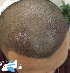 -大麦微针植发丨全国连锁