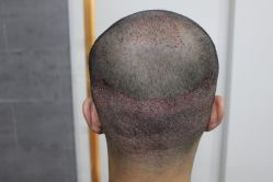 点击看大图 -大麦微针植发丨全国连锁