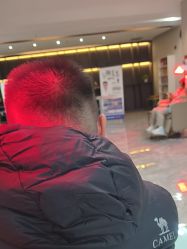 -碧莲盛·不剃发植发