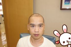 -大麦微针植发丨全国连锁