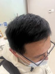 体验后-大麦微针植发丨全国连锁