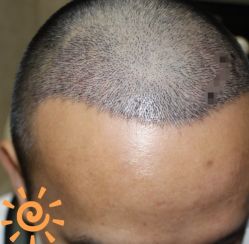 -大麦微针植发丨全国连锁