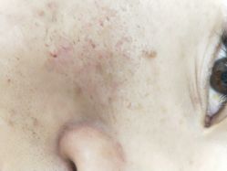 -苗方清颜祛痘·皮肤管理