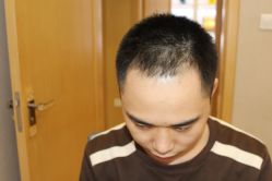 -大麦微针植发丨全国连锁