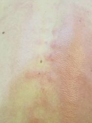 -苗方清颜专业祛痘养生