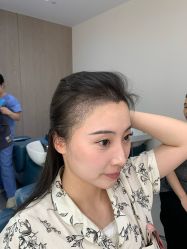 -大麦微针植发全国连锁