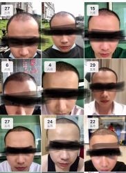 点击看大图 体验后-大麦微针植发全国连锁