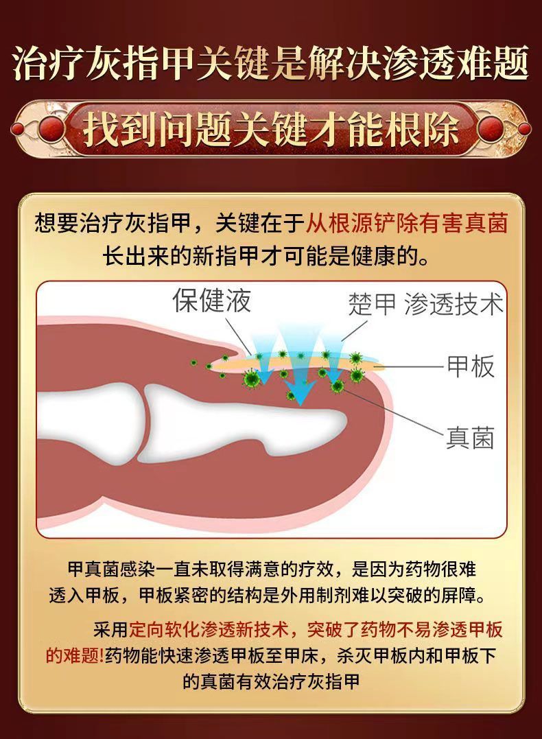 灰指甲如何根除图片