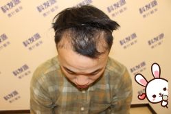 -大麦微针植发丨全国连锁